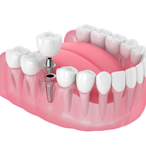 Dental Tourism Process